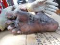 Jigger_infested_foot_(2).jpg