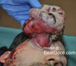 what-eye-lid-skin-cancer-looks-like-840x740.jpg