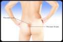 boils_s6_pilonidal_cyst.jpg