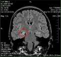 MRI5.png
