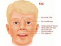 fetal-alcohol-syndrome.jpg