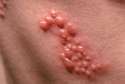 shingles.jpg