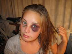 Black-Eye[1].jpg