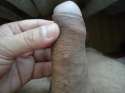 Scabies_Penis_1.jpg