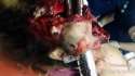 young-man-impalement-through-face-metal-rail-840x474.jpg
