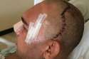 Cyborg-Santos-after-surgery-on-his-skull1.jpg