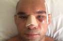 Cyborg-Santos-after-surgery-on-his-skull.jpg