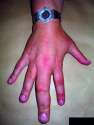 swollen-finger.jpg
