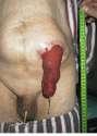 Prolapsed-Stoma-Photo.jpg