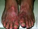 ugly+feet.jpg