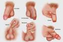 shingles treatment.jpg