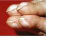 Clubbing-finger-3.jpg
