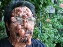 acne.jpg