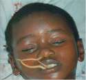 AscarisInMouthandNose.jpg