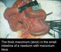 meconium6[1].jpg