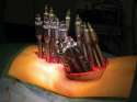 Scoliosis Surgery .jpg