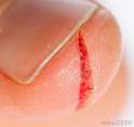 closeup-of-thumb-with-cut-near-nail.jpg