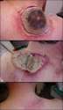 Neck_lesion.jpg