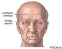 foreheadwrinkles.jpg