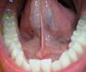 bump-under-tongue.jpg