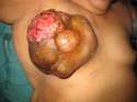 2_Gross_tumor_pre_op.jpg
