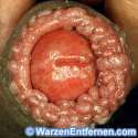 feigwarze-am-penis.jpg