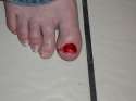Cody's Toenail 2.jpg