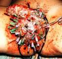 multiple-testicular-impalement-300x288.jpg