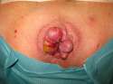 3_Hemorrhoids_3-7-11.jpg