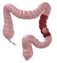 colon_cancer.jpg