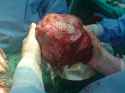 Big_Liver_Tumor.jpg