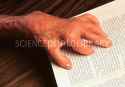 tmp_13103-M1100391-Severely_deformed_hand_of_patient_with_arthritis-SPL-942699882.jpg