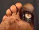 syph ulcer toe.jpg
