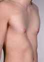 pectus-excavatum-exercises-1[1].jpg