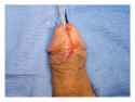 a-An-extended-meatotomy-is-made-through-the-stricture-b-Glans-wings-are-mobilized.png