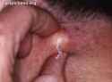 pictures-of-bartholin-cyst.jpg