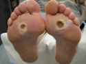 Diabetic Foot.jpg