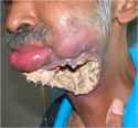 oral-cancer-myiasis01.jpg