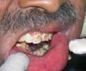 oral-cancer-myiasis02.jpg