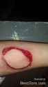 arm-injury-explosion-spray-can-01.jpg