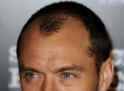 Receded-Hairline.jpg
