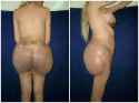 another-failed-butt-and-breast-implant.jpg