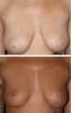 13498_Breast_Lift_Dr._Placik_Chicago_Illinois_Arlington_Heights.jpg