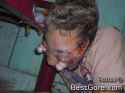 gunshot-temple-eyes-popped-out-sockets-03.jpg
