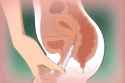 Tampon3.gif