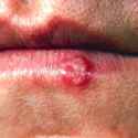 red herpes.jpg