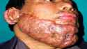 keloid-2.jpg