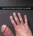 broke my thumb.jpg