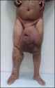 ScrotalElephantiasis.jpg