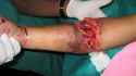 elbow degloving %283%29.jpg